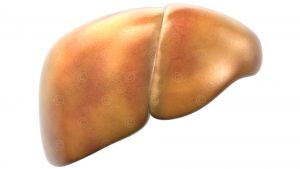 Image of a fatty liver - Stage 1-2 of fatty Liver
