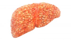 Liver cirrhosis - Stage 4